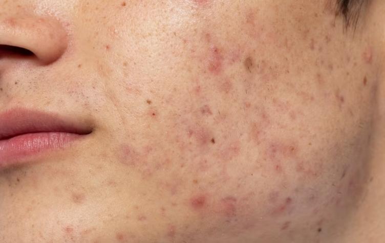 Acne and Pimple Control